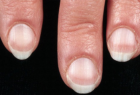 Nail Abnormalities - Part 2 (Koilonychia, Clubbing & Onycholysis) - The Nail  Bar Beauty & Co.