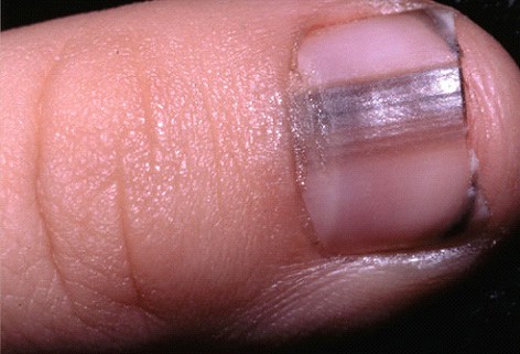 Nail Trauma - Harvard Health