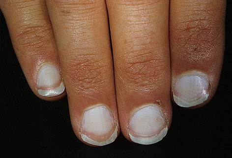 Diseases of the Nails: Slideshow