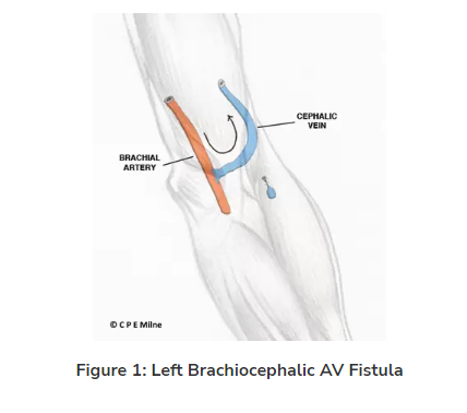 Arteriovenous (AV) Fistula Formation